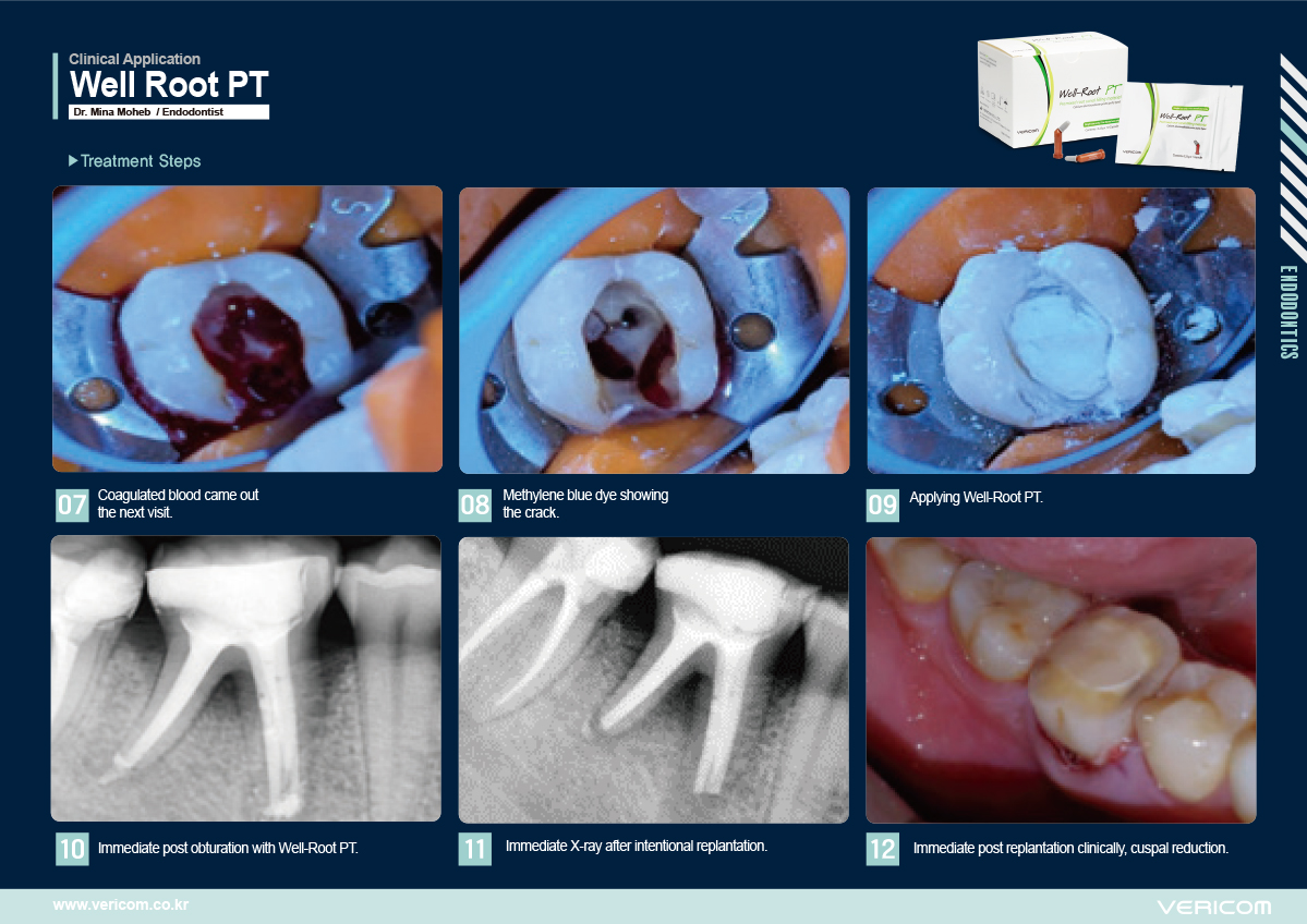 [ 임상적용 리포트 ] Well-Root PT_ENG_MinaCase_고화질-5 복사.jpg